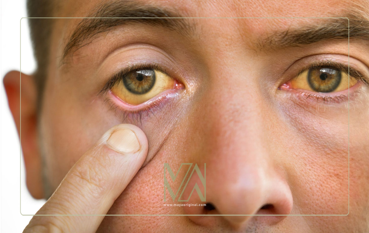 زردی - تاثیر مشکلات کبدی