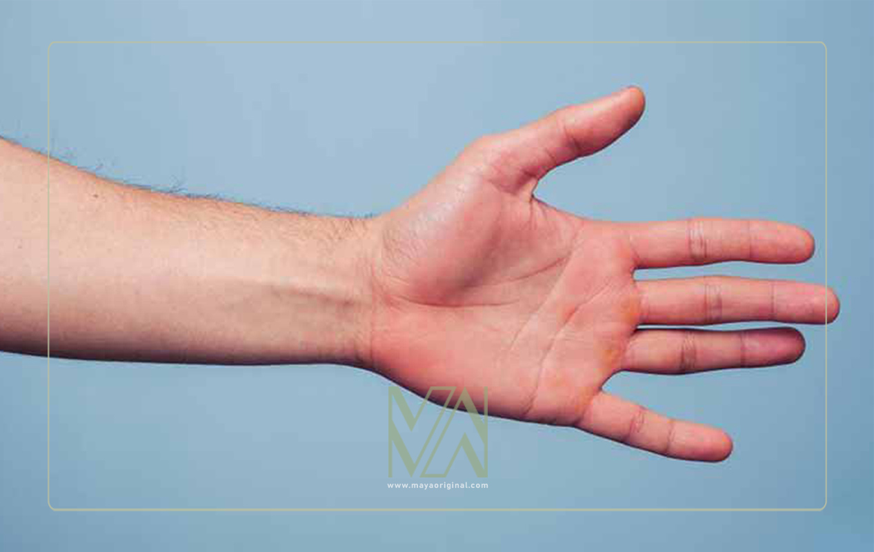 قرمز شدن کف دست - مشکلات کبدی