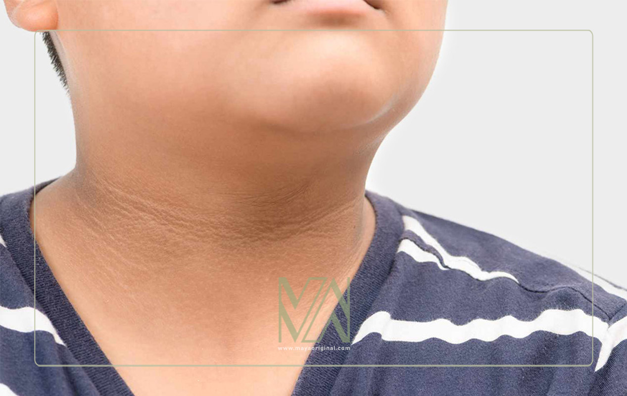 آکانتوز نیگریکانس - تاثیر مشکلات کبدی