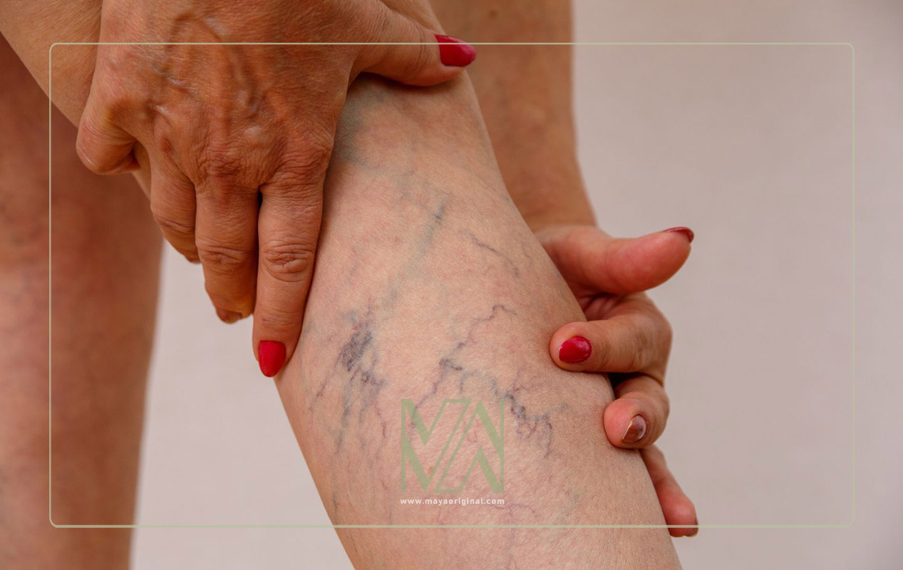 وریدهای عنکبوتی - تاثیر مشکلات کبد روی پوست