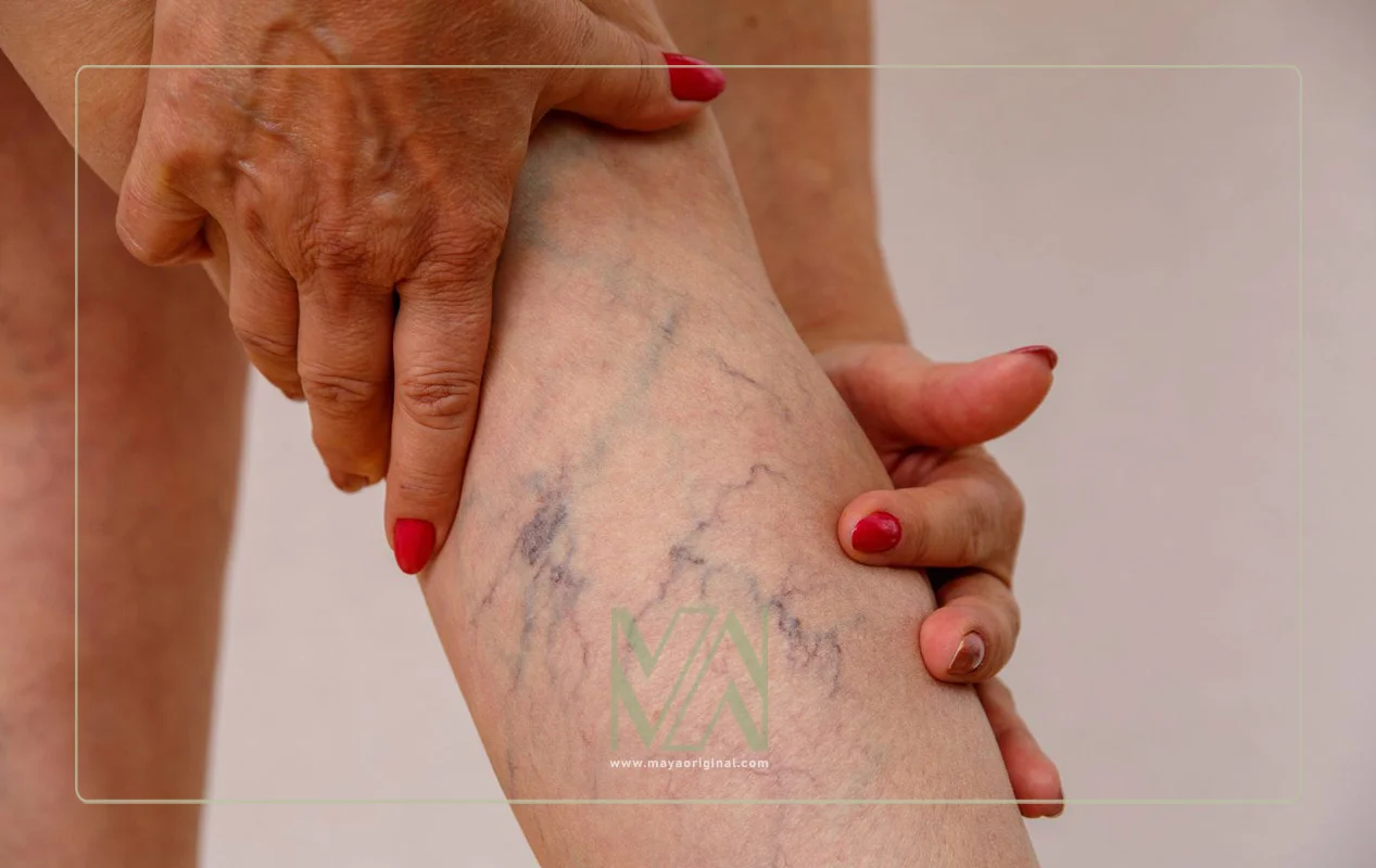 وریدهای عنکبوتی - تاثیر مشکلات کبد روی پوست