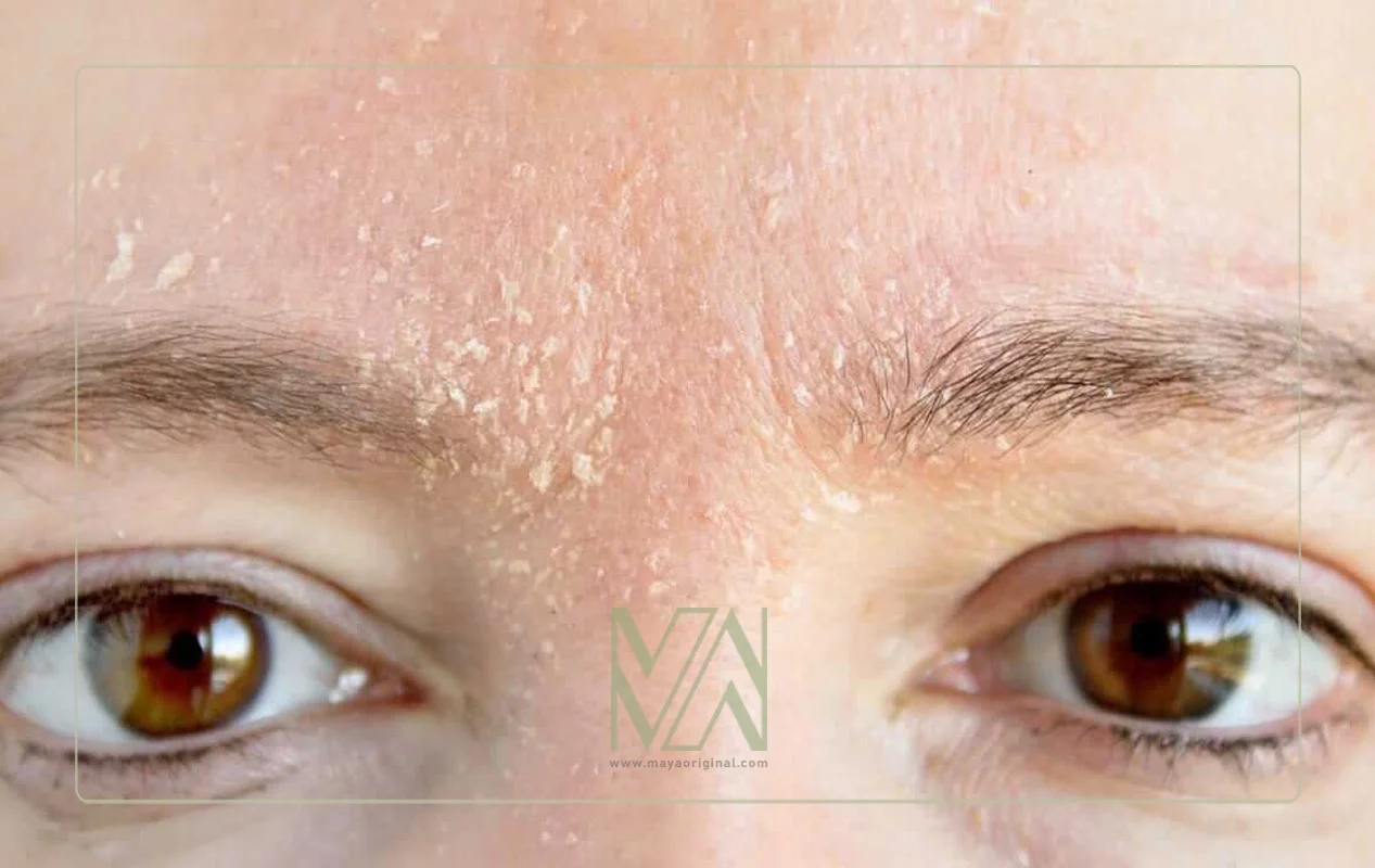 درماتیت - مشکل کبد روی پوست