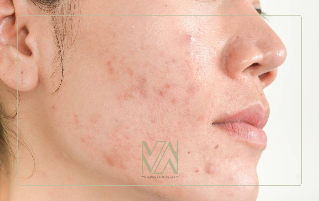 تاثیر مشکلات کبدی روی جوش و آکنه