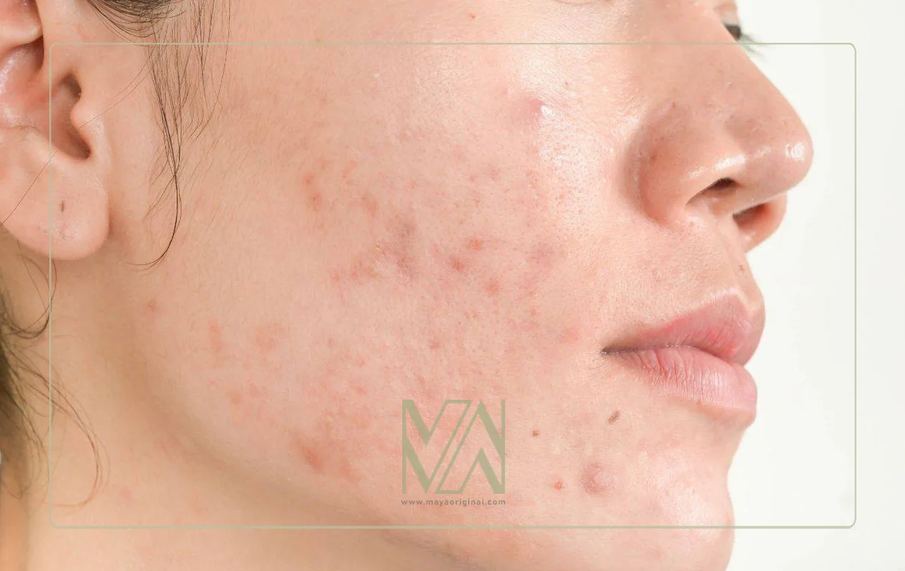 تاثیر مشکلات کبدی روی جوش و آکنه