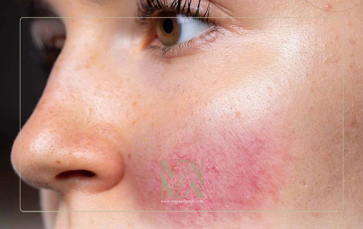 روزاسه چیست؟