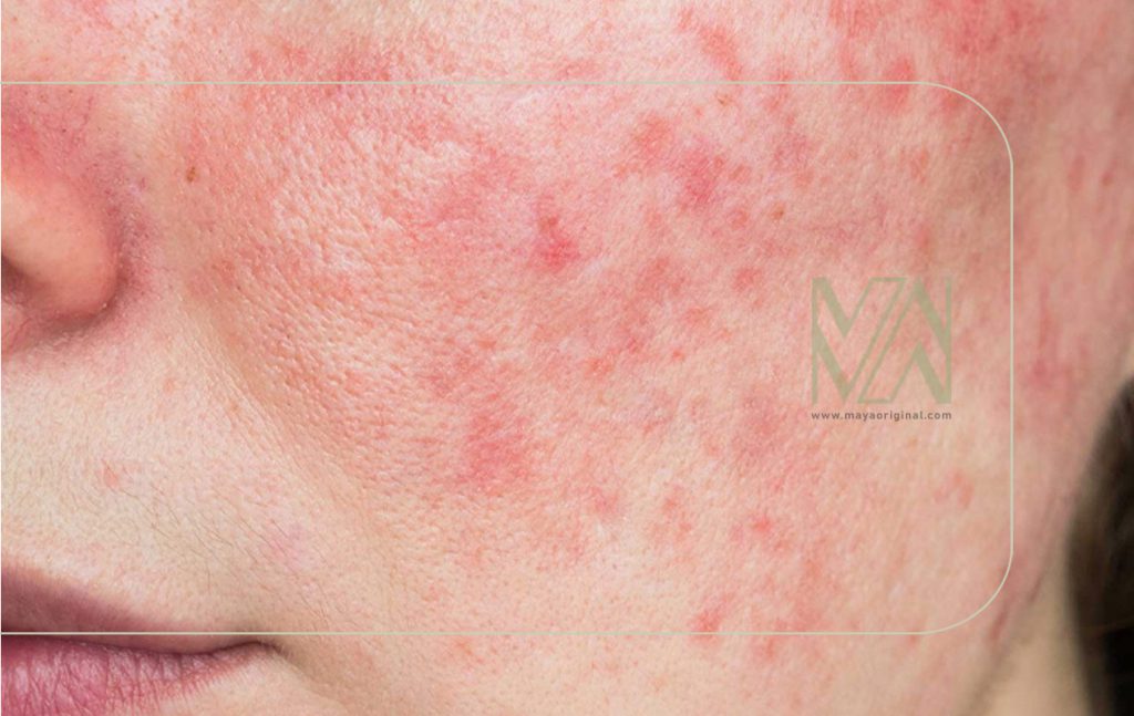 جوش و مشکلات کبدی