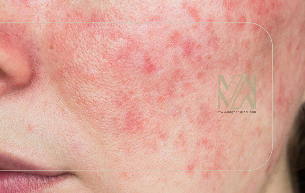 جوش و مشکلات کبدی