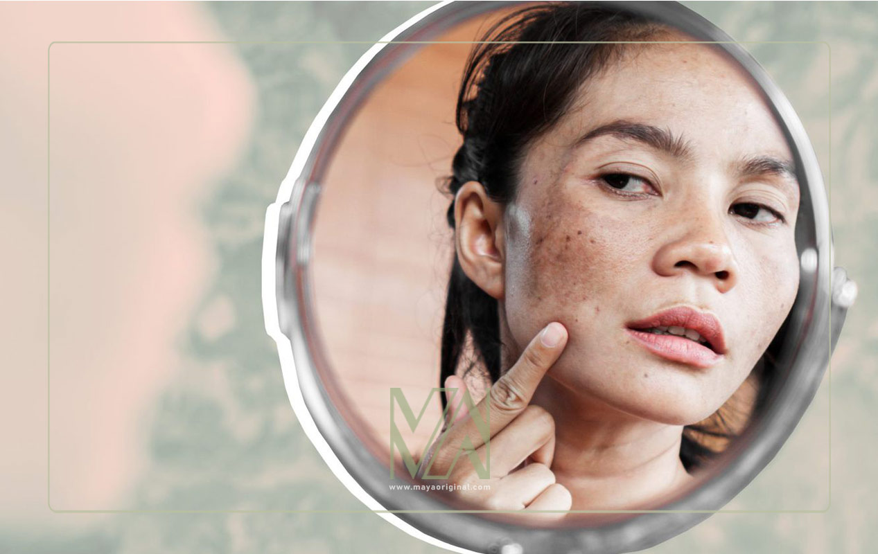 درمان ملاسما