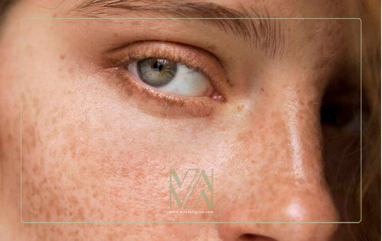 آیا ملاسما درمان دارد؟