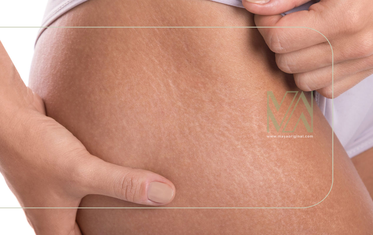 درمان ترک پوستی یا استرچ مارک