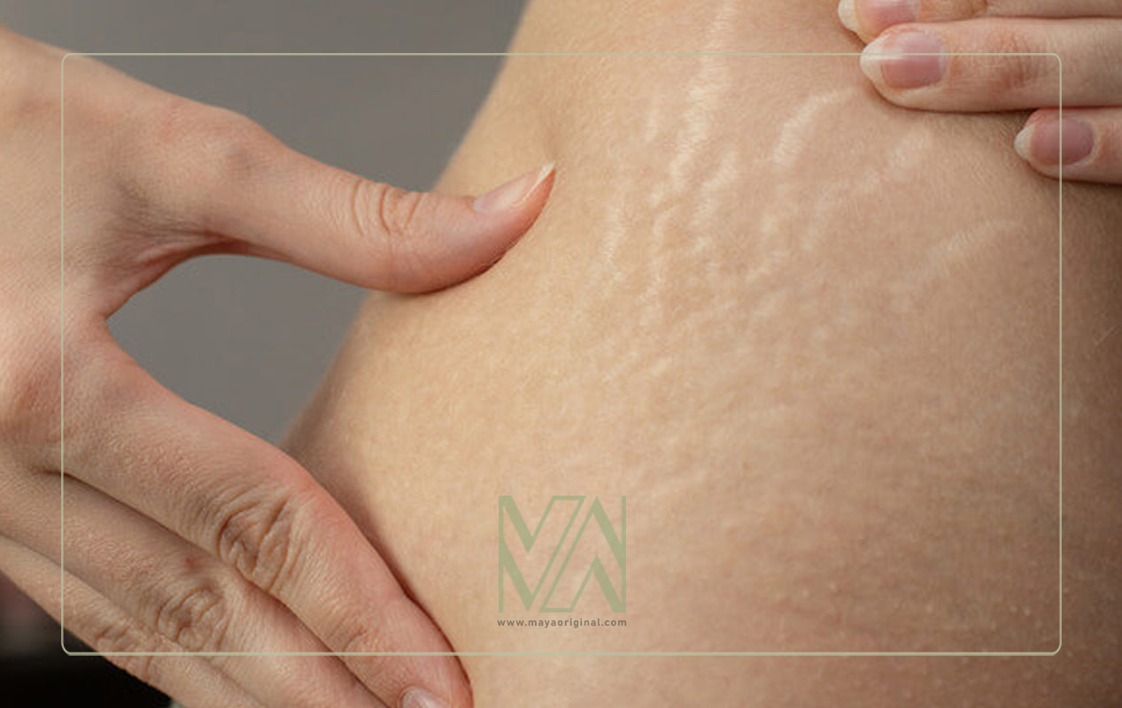 ترک های پوستی یا استرچ مارک