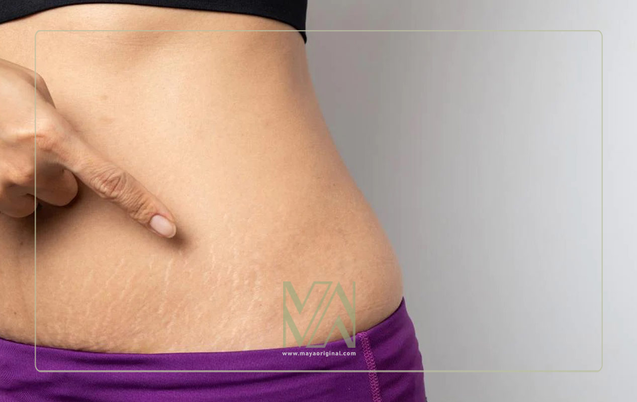 استرج مارک و درمان آن