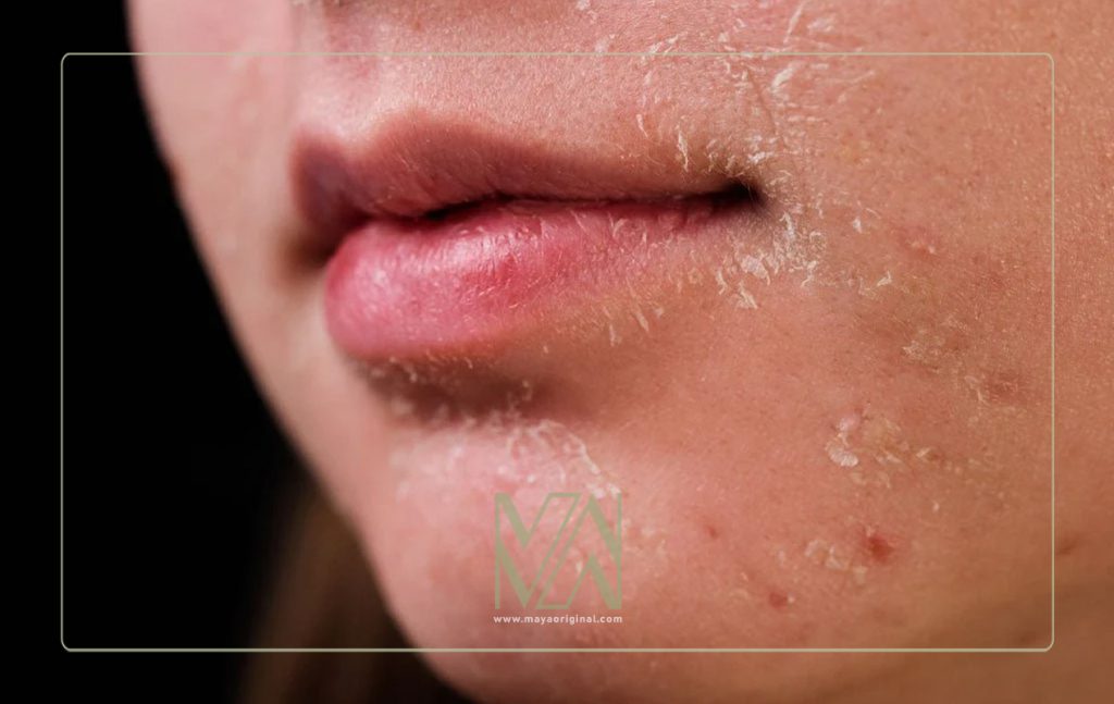 پیشگیری از خشکی پوست