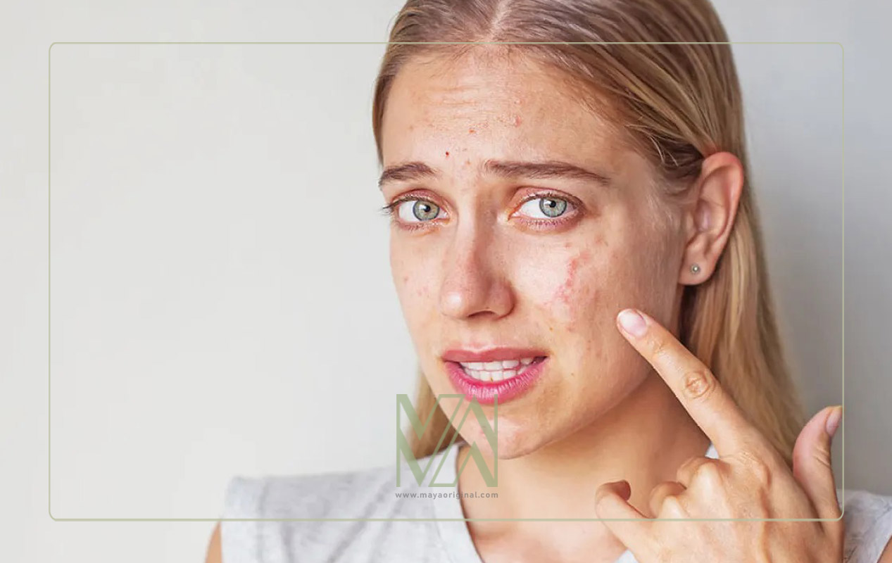 کنترل جوش صورت در دوران بلوغ و نوجوانی