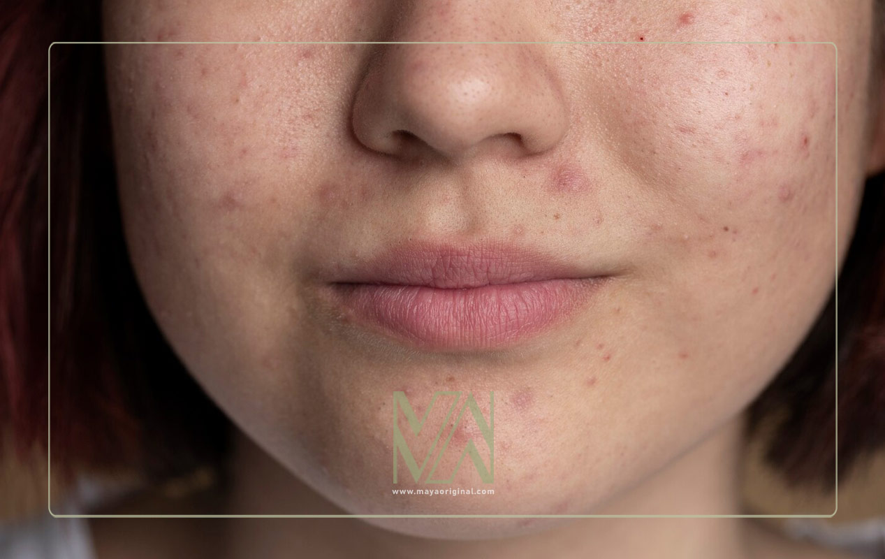 کنترل جوش و چربی صورت در دوران بلوغ