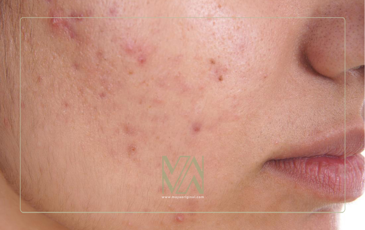 تاثیر قند روی جوش و آکنه