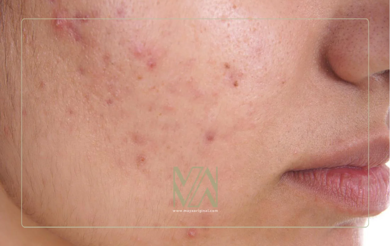 تاثیر قند روی جوش و آکنه