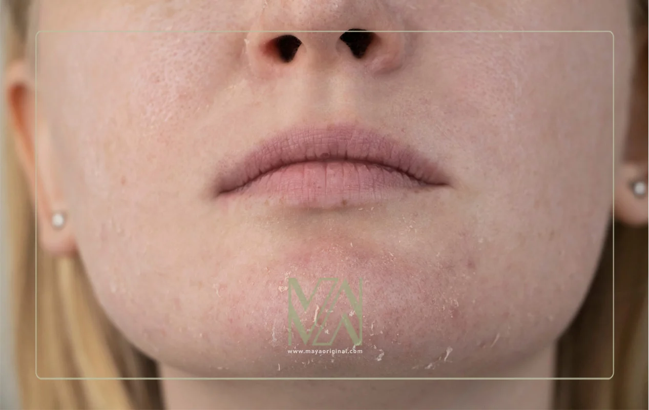 تاثیر قند روی خشکی و کم آبی پوست