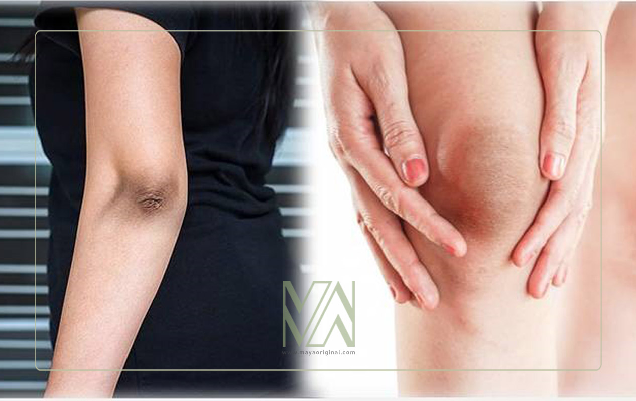 علت تیرگی زانو و آرنج