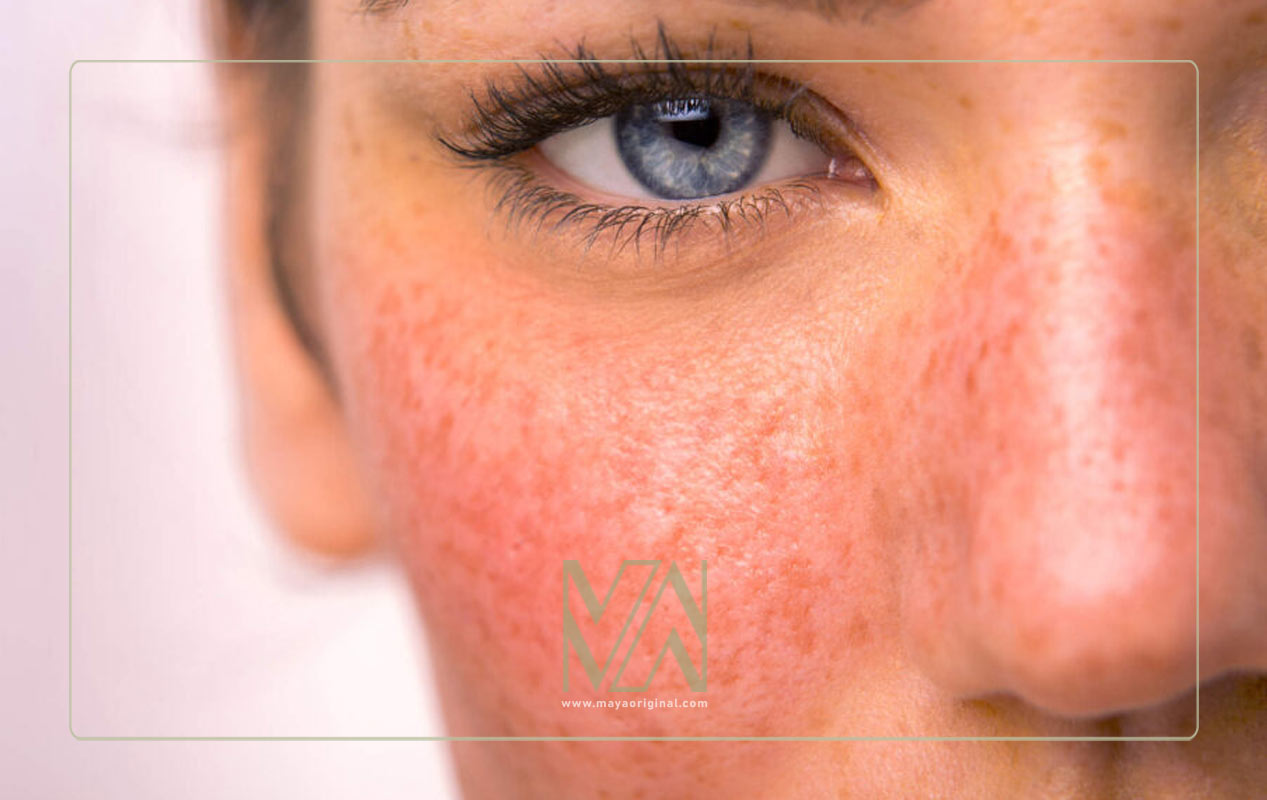 دلایل و علائم کهیر و درمان آن