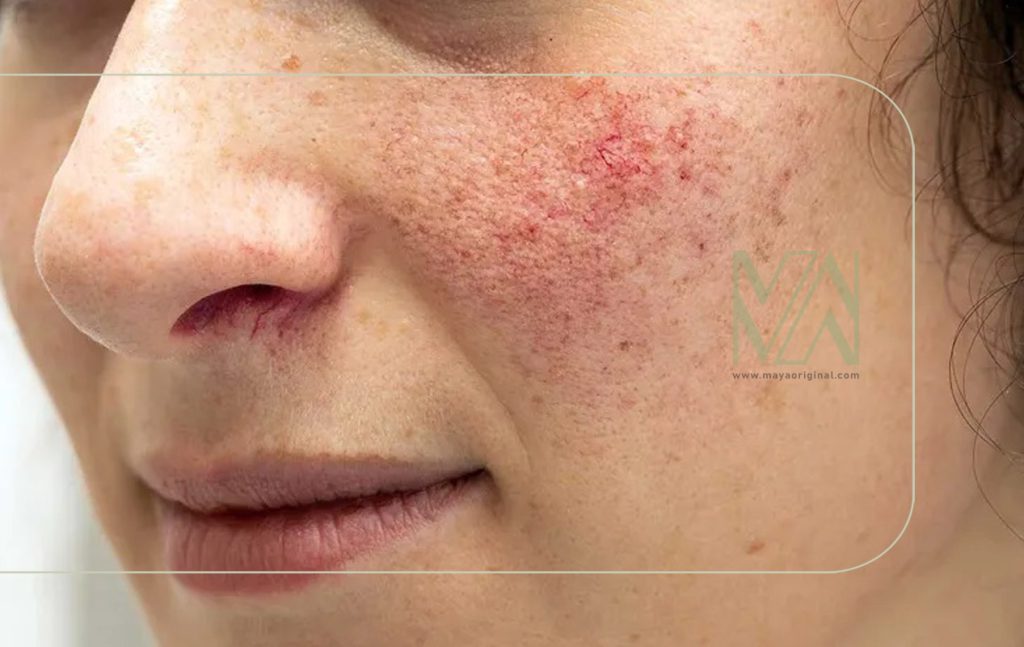 دلایل ایجاد کهیر و راههای کنترل و درمان آن