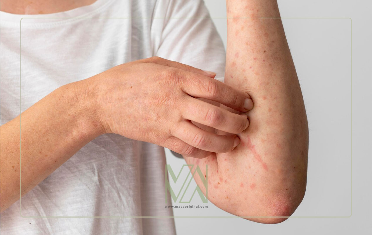 دلایل اصلی اگزما