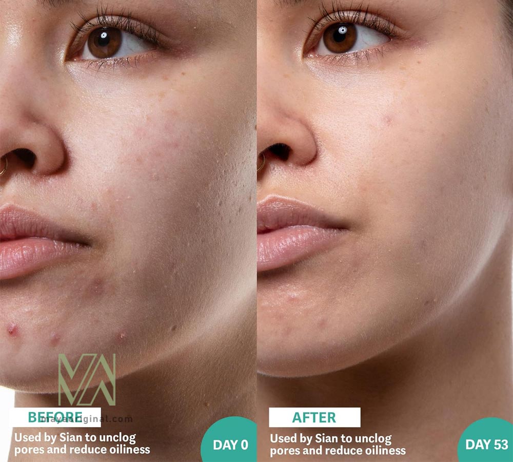 selfless-hyram-salicylic-breakouts-acne-prone-maya-03 سرم سالیسیلیک اسید اینکی لیست - ضد منافذ و جوش