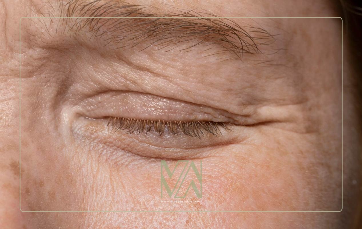 بهترین سن برای جلوگیری از افتادگی و شل شدن پوست