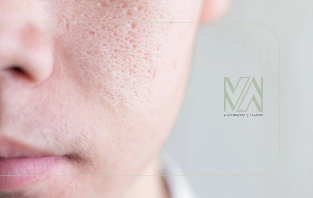 تأثیر تغذیه بر منافذ باز پوست