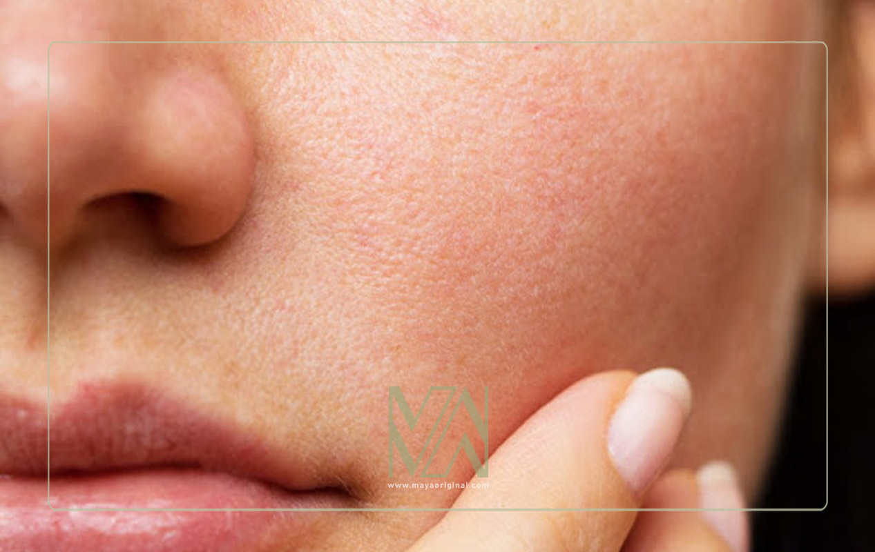 تغذیه و منافذ باز پوست