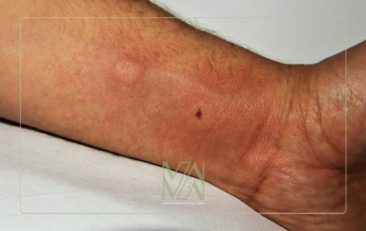 خارش پوست بدن