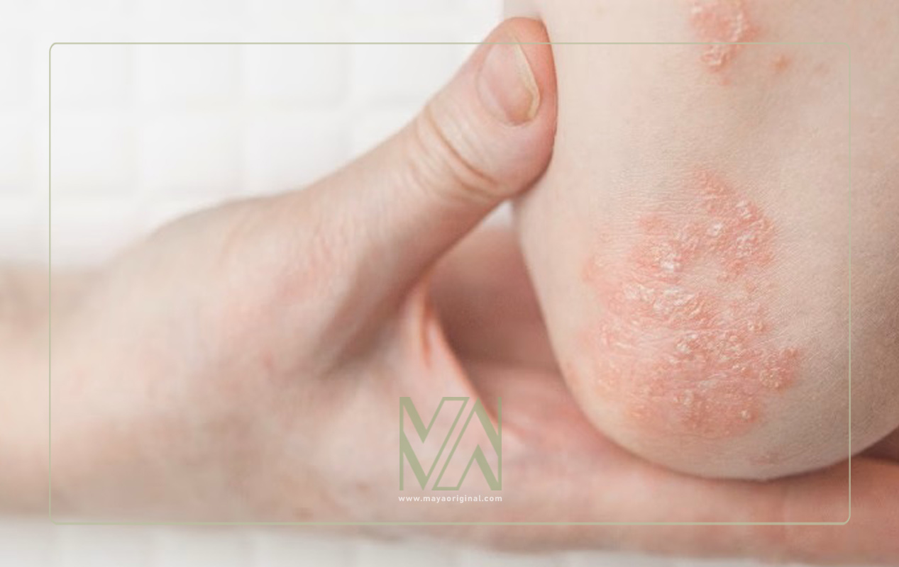 اگزوما دلیل خارش پوست