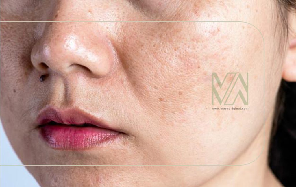 مهم ترین دلایل ایجاد تیرگی هلالی شکل روی گونه