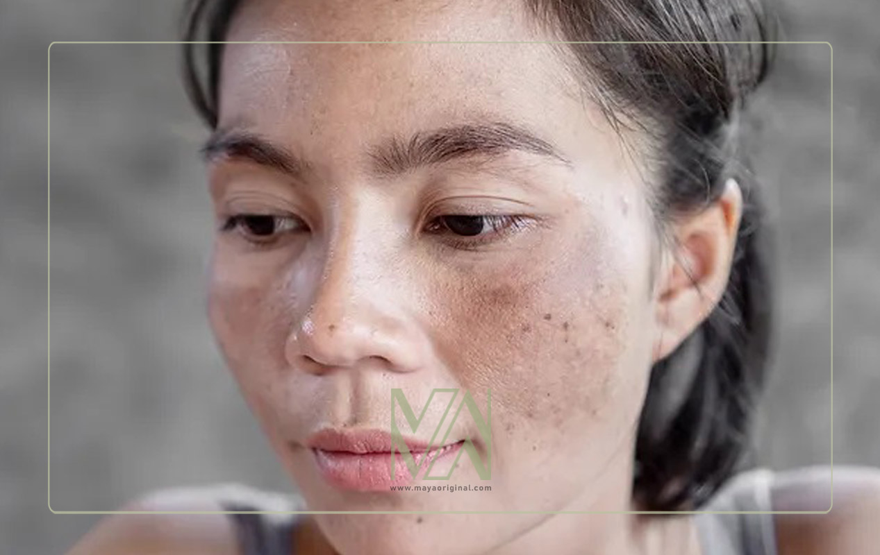 لکه های هلالی شکل بر روی گونه ها