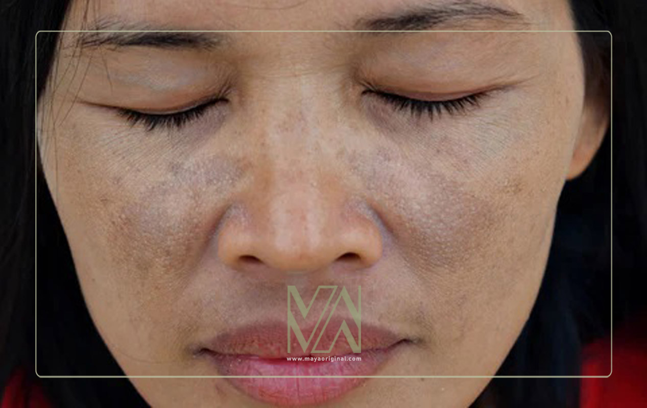 چگونه لکه های پوستی را ازبین ببریم؟