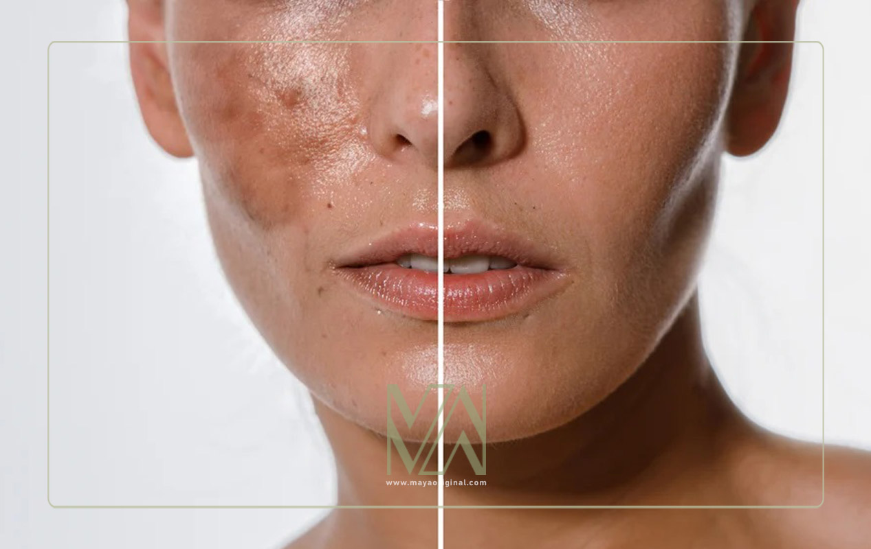 لکه های هلالی روی گونه ها