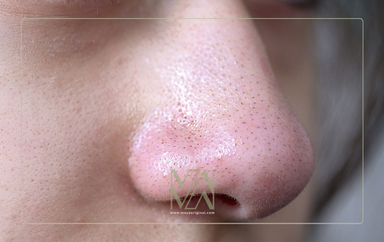 سالیسیلیک اسید برای جوش های سرسیاه