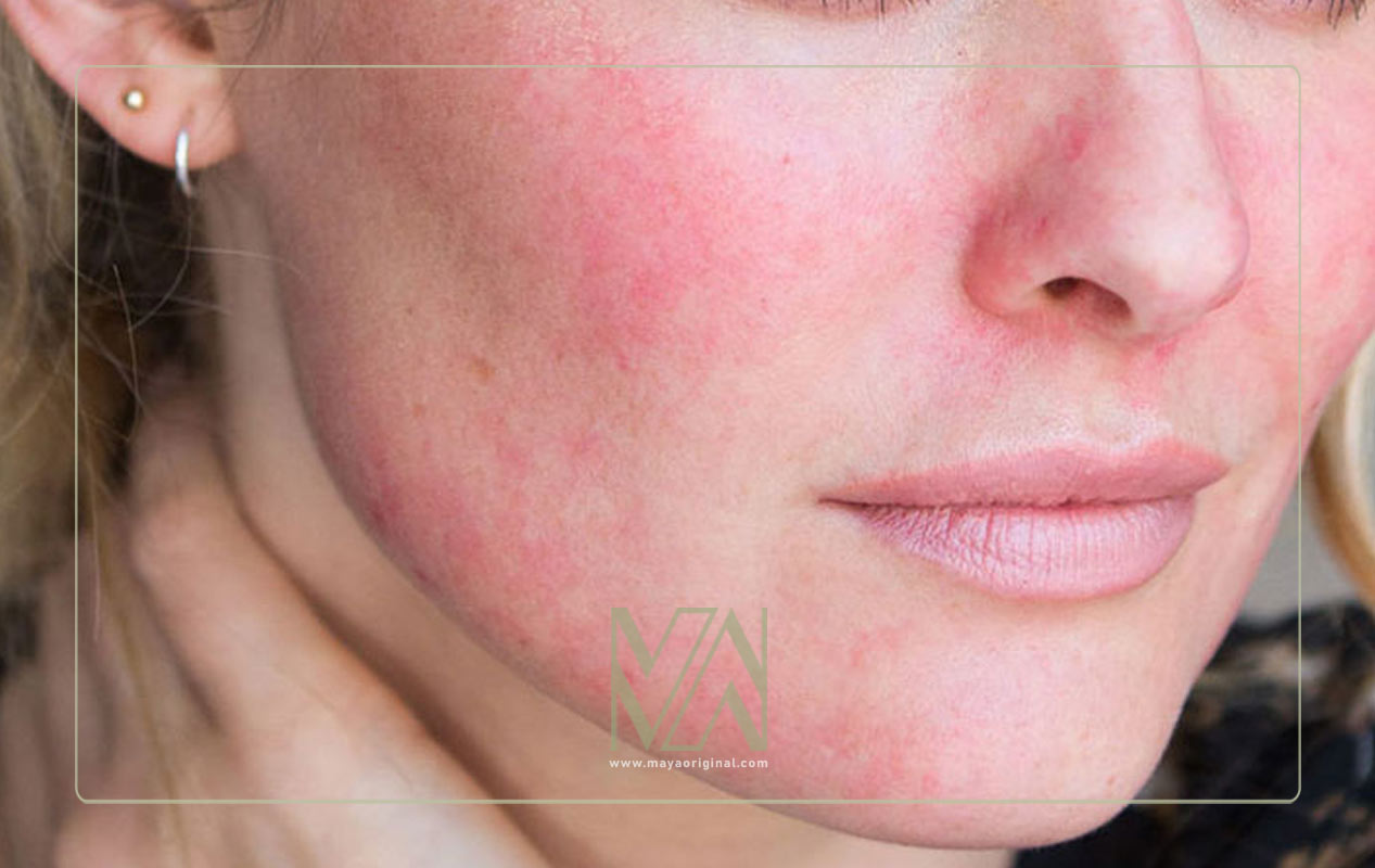 موارد احتیاط استفاده از سالیسیلیک اسید