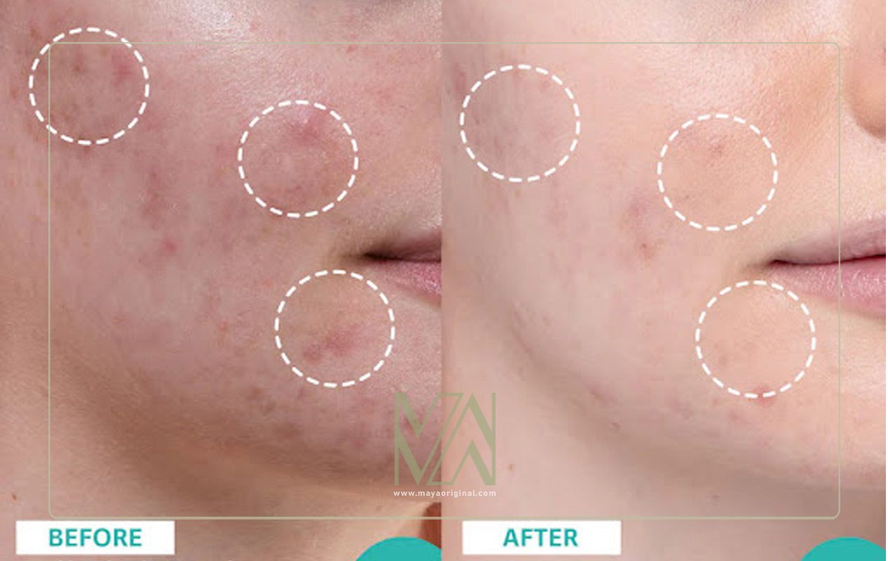 سالیسیلیک اسید برای چه کسانی مناسب است؟