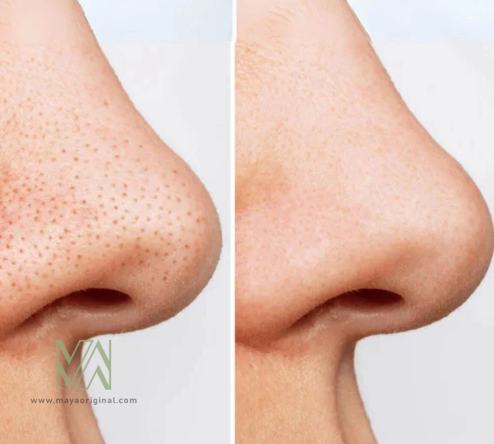 ANUA-Heartleaf-Pore-Cleansing-Oil-MILD-maya-01 روغن پاک کننده و کنترل منافذ آنوا کره