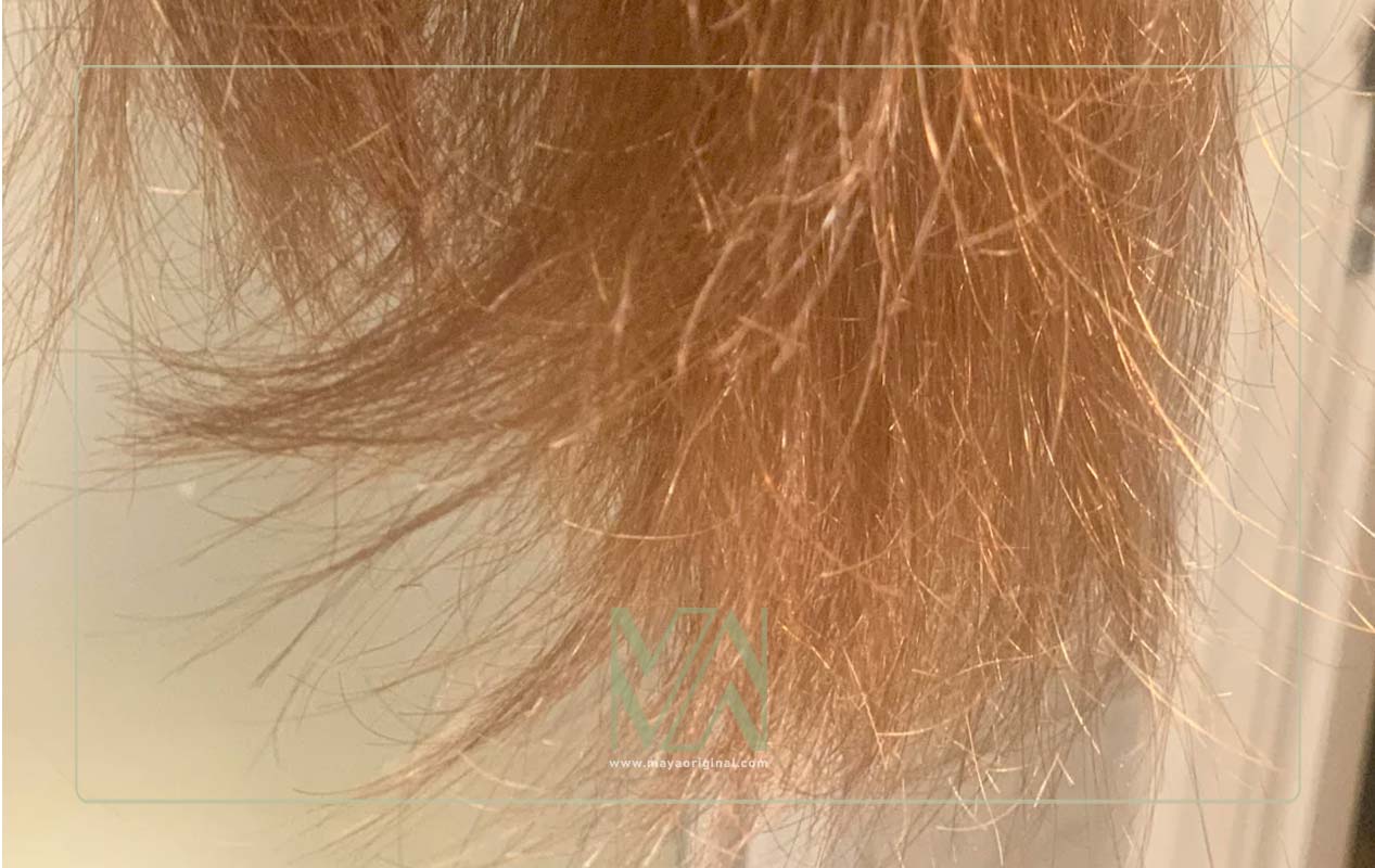 جلوگیری از موخوره گرفتن مو