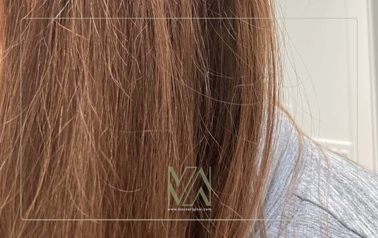 نکات مهم برای جلوگیری از موخوره